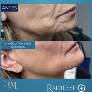 Radiesse