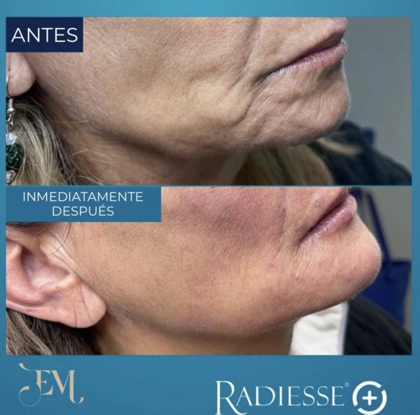 Radiesse