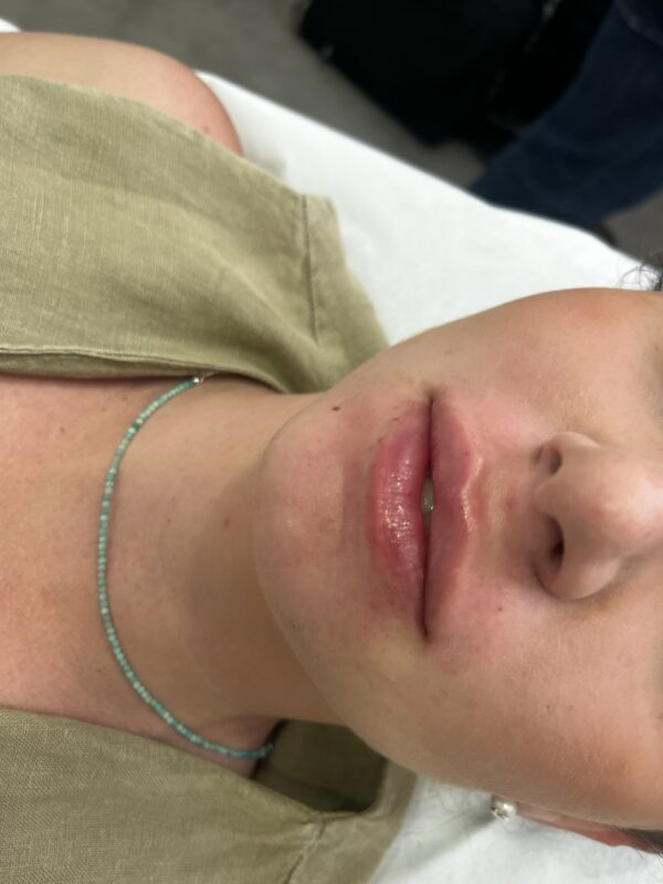 Aumento de Labios