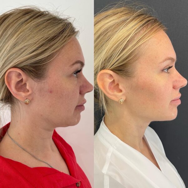 Marcación Mandibular - Imagen 2